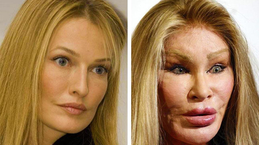 Cosmetic Surgery Gone Wrong.