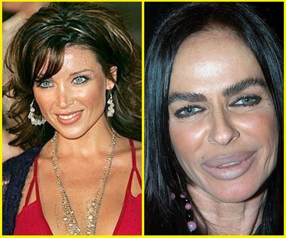 Cosmetic Surgery Gone Wrong.