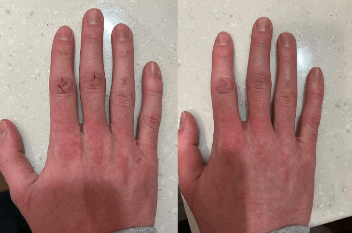 Skin care for cracked hands