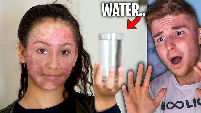 Rarest diseases in the world-Water allergy