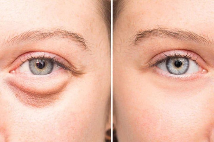 Benefits of using ice on face- Reduce Puffy Eyes