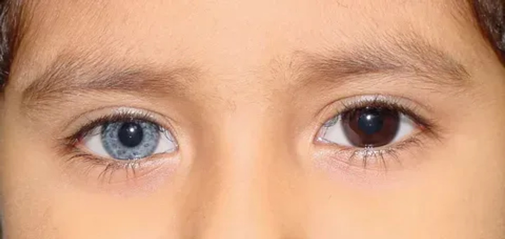 Eye colors that are considered uncommon in humans: Heterochromia