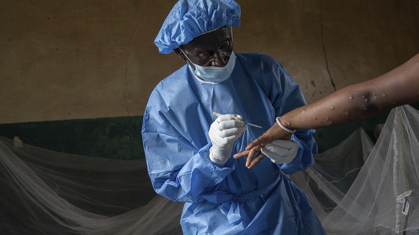 Why the Democratic Republic of the Congo is struggling to contain mpox