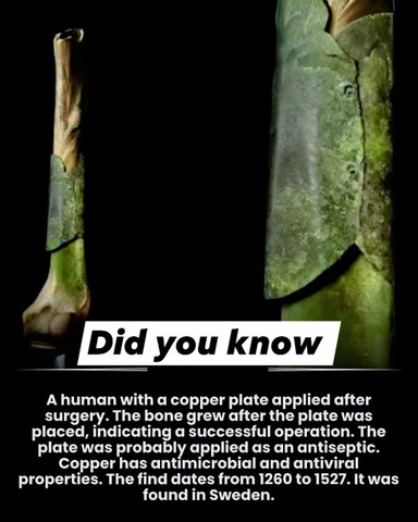 A human with a copper plate applied after surgery